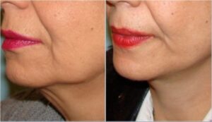 لیفت صوررت و گردن