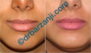 تزریق ژل جوویدرم در لب