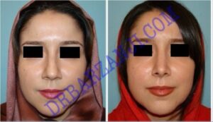 جراحی بینی، ۶ ماه بعد از عمل