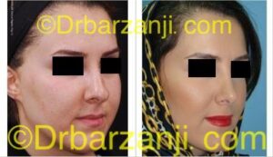 عمل جراحی زیبایی بینی یک سال بعد