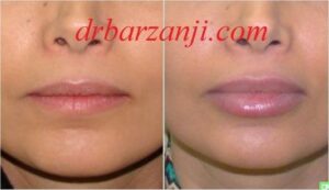 تزریق ژل جوویدرم در لب