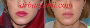 تزریق ژل برای بهبود غیر قرینگی فک