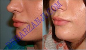 تزریق ژل ژوویدرم به لب ، ٤ ماه بعد