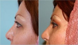 جراحی زیبایی پلک بالا،۳ سال بعد از عمل