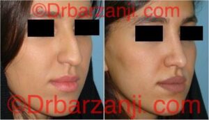 عکس عمل جراحی پلاستیک بینی ۶ ماه بعد