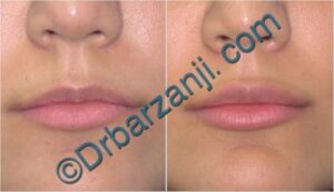 تزریق جوویدرم به لب سه هفته بعد