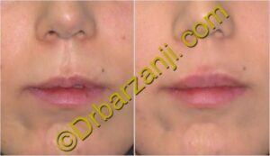 تزریق ژل لب