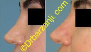 تزریق ژل رستیلن در بینی عمل شده