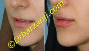 تزریق ژل لب