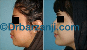 پروتز چانه و لیپوساکشن غبغب