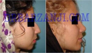 پروتز چانه و جراحی بینی، یک سال بعد از عمل