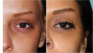 تزریق ژل زیر چشم