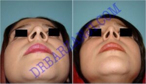 جراحی بینی، ۶ ماه بعد از عمل