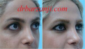 تزریق چربی زیر چشم ها