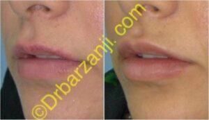 تزریق ژل جوویدرم ( ژوویدرم ) به لب یک هفته بعد