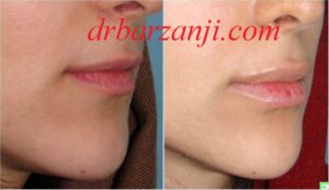 تزریق فیلر ژوویدرم در لب