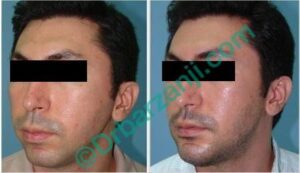 پروتز چانه دو هفته بعد از عمل