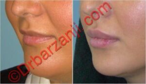 تزریق ژل جوویدرم ( ژوویدرم ) به لب پانزده ماه بعد