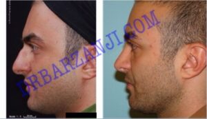 عمل جراحی پلاستیک بینی ٢ سال بعد