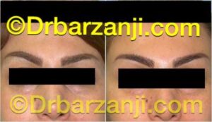 قرینه کردن ابروها با بوتاکس ( دیسپورت )