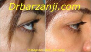 تزریق ژل رستیلن زیر چشم