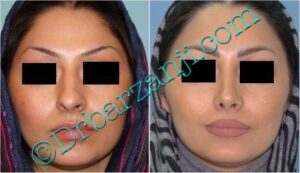 عمل جراحی پلاستیک بینی ( رینوپلاستی )