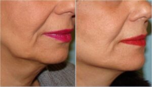 لیفت صورت وگردن