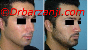 پروتز چانه یک هفته بعد از عمل