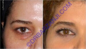 جراحی پلک بالا و پایین، دو ماه بعد از عمل