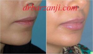 تزریق ژل جوویدرم در لب