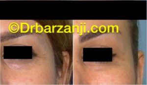 کاهش خطوط کنار چشم در هنگام خنده با تزریق بوتاکس ( دیسپورت )