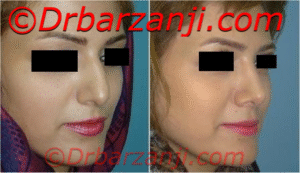 عکس قبل و بعد جراحی پلاستیک بینی شش ماه بعد