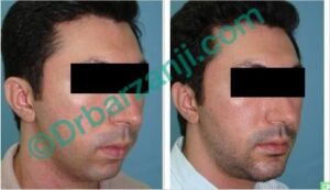 پروتز چانه دو هفته بعد از عمل