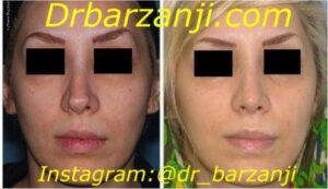 جراحی ترمیمی بینی دو هفته بعد از عمل