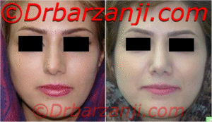 عکس قبل و بعد جراحی پلاستیک بینی شش ماه بعد