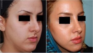 جراحی پلاستیک بینی٣ سال بعد از عمل