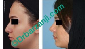 عمل جراحی پلاستیک بینی یک سال بعد