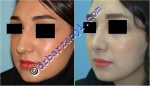جراحی پلاستیک بینی یک سال بعد از عمل