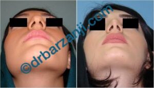 جراحی بینی یک سال و نیم بعد از عمل