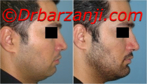 پروتز چانه یک هفته بعد از عمل