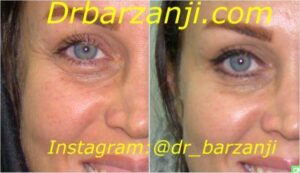 بهبود چین و چروک اطراف چشم با تزریق بوتاکس ( دیسپورت )