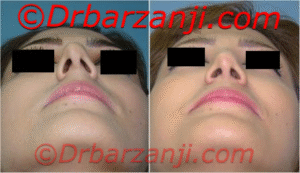 عکس قبل و بعد جراحی پلاستیک بینی شش ماه بعد