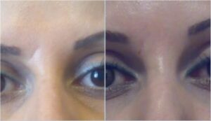 تزریق ژل در ناحیه خط اخم