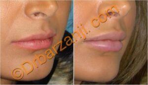 تزریق ژل جوویدرم ( ژوویدرم ) به لب یک ماه بعد