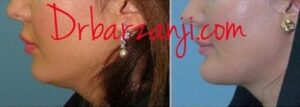 پروتز چانه و لیپوساکشن غبغب