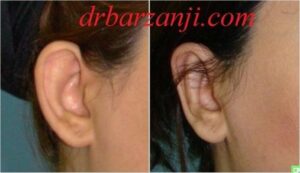 جراحی لاله گوش