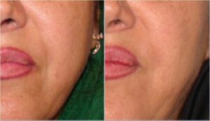 تزریق ژل جوویدرم در خطوط اطراف لب و بینی، ٦ ماه بعد