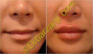 تزریق ژل جوویدرم در لب