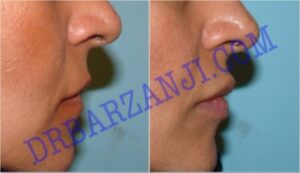 تزریق ژل جوویدرم در لب