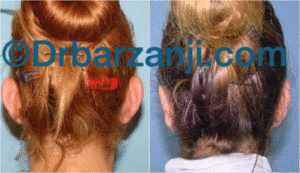 جراحی پلاستیک لاله گوش یک سال بعد از عمل